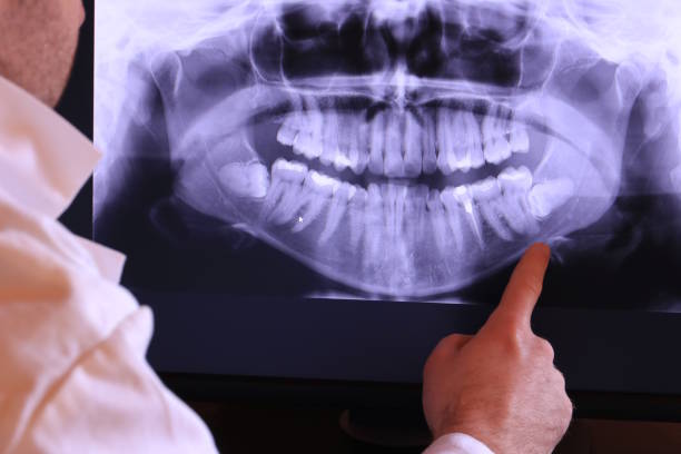 Best Emergency Treatment for Dental Infections or Abscesses in Paterson, NJ